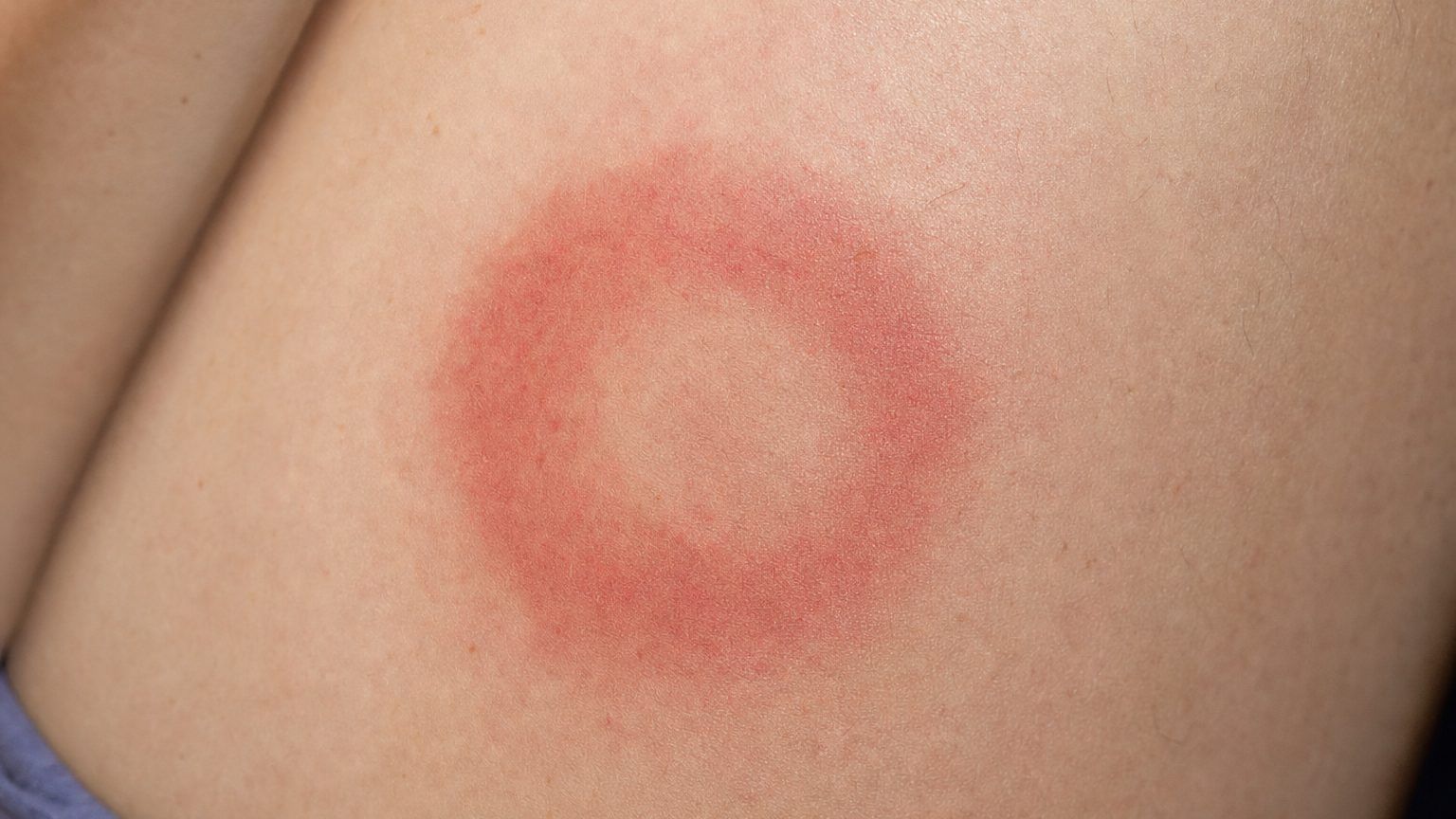 Érythème migrant en forme de cible sur la peau, signe précoce de la maladie de Lyme
